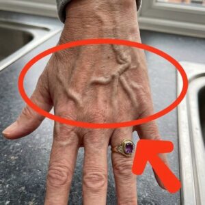 What Bulging Veins Can Mean