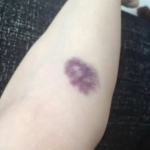 BE CAREFUL, if you get these bruises on your body, it means you have Ca…see more