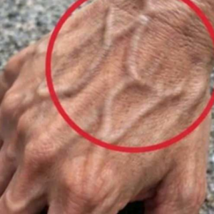 What Bulging Veins Can Mean