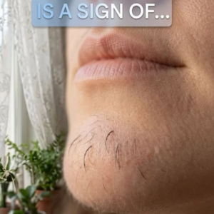 What Chin Hair in Women Really Says About Horm:ones