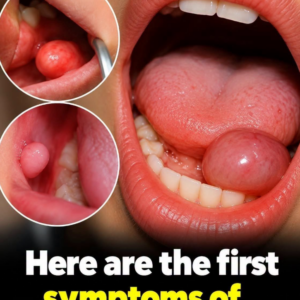 Oral Growths: Early Symptoms, Possible Causes, and When to Seek Dental Care
